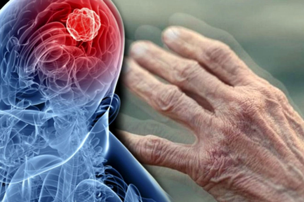 Tarım İlaçları Parkinson Riskini Artırabilir